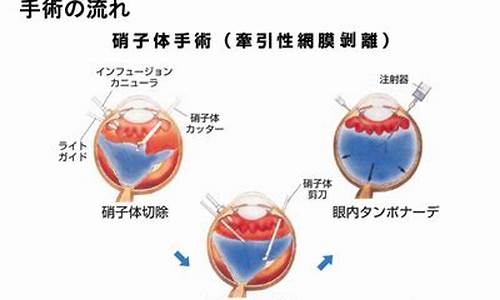 ppv眼科_ppv眼科医学上指什么