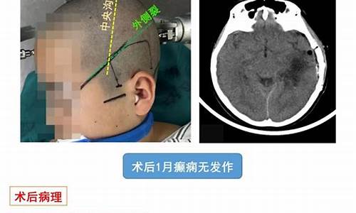 左侧颞叶手术后遗症-做完左颞叶手术癫痫