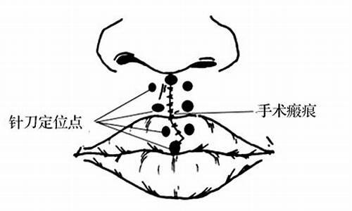 天气太冷适合唇裂手术吗_天气太冷适合唇裂