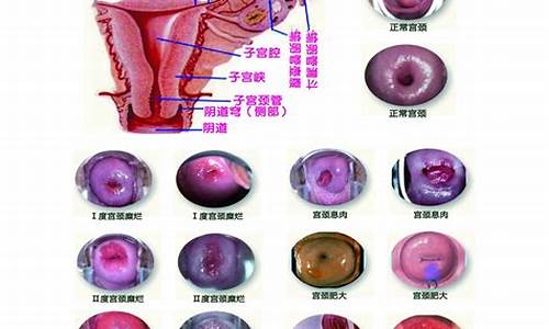 宫颈疾病的特征是什么_宫颈疾病的特征