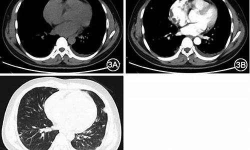心包结核一般寿命多长_心包结核需要吃多久