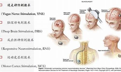 手术治疗癫痫的原理-手术治癫费用多少钱