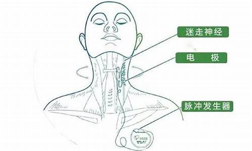 癫痫姑息术治疗什么意思-癫癫怎么治疗好