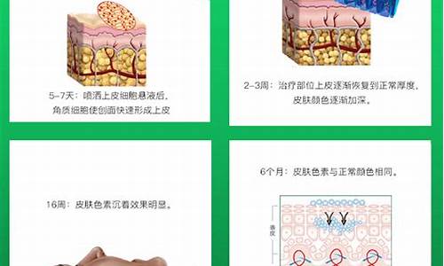 白癜风细胞移植_黑色素移植费用一般是多少