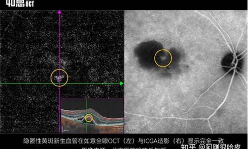 眼科oct检查是什么_眼科oct检查的意义