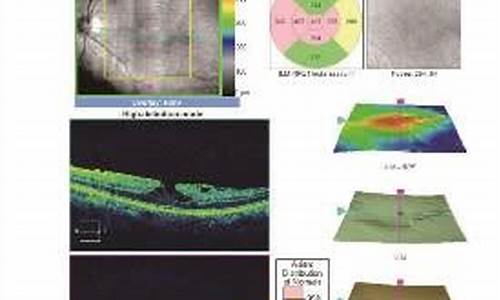 眼科检查oct是什么意思_眼科oct检查
