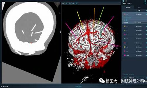 立位定向术能治疗癫痫吗-立体定向手术治疗