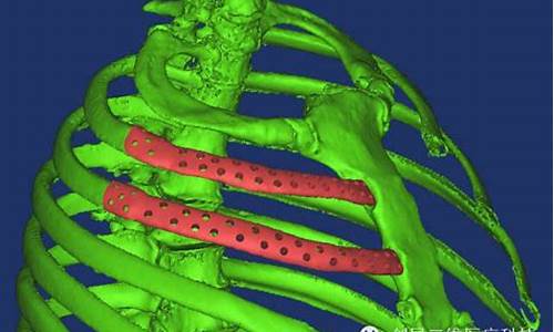 肋骨固定钛合金价位_肋骨手术用钛合金固定术后不取有后遗症吗?