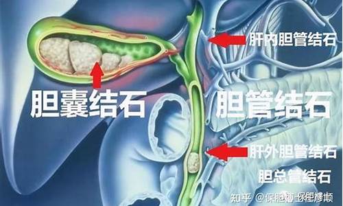 胆结石能振吗?-胆结石可以治疗癫痫吗