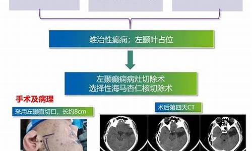 胶质瘤术后还会抽搐吗-胶质瘤手术引起癫痫