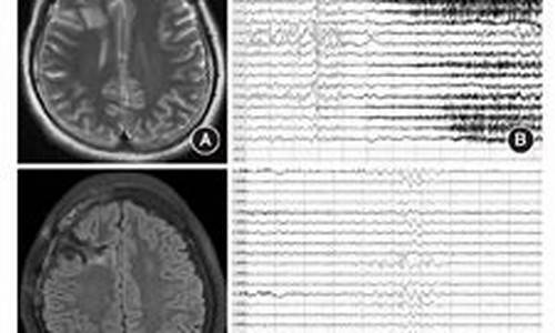 脑手术癫痫持续状态-脑部手术后发癫