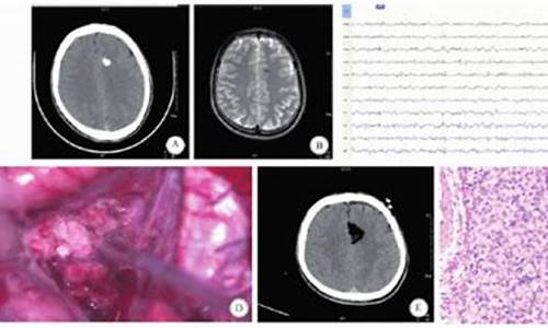 脑膜瘤 血管-脑膜血管瘤引发癫痫治疗