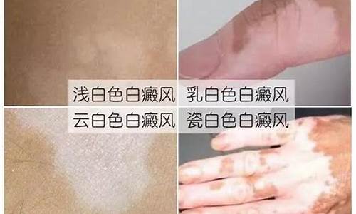 非结节是什么_非节段型白癜风是什么意思