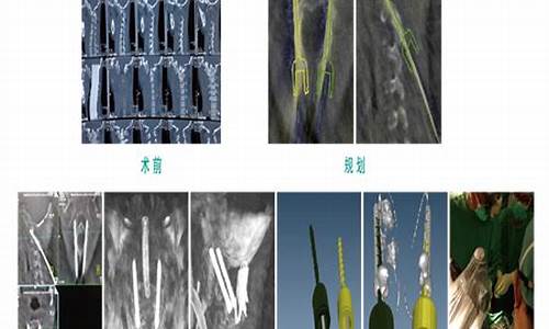 颈椎手术导致癫痫-颈椎手术后会引起头晕吗